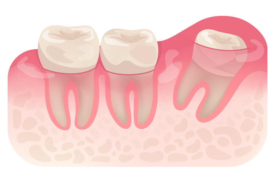 Disoangular Distoangular Impaction