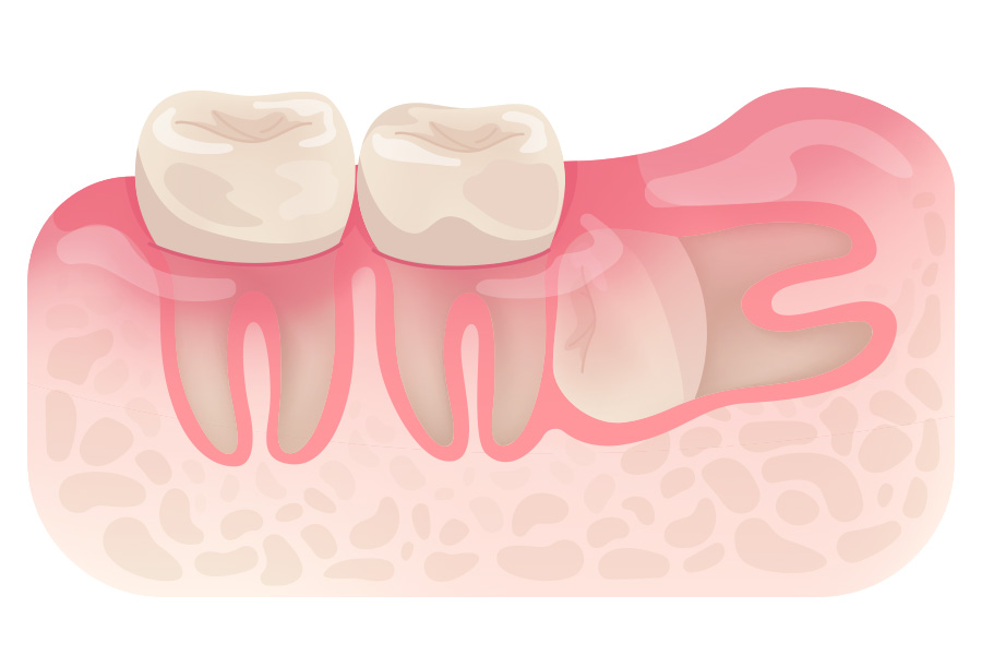 Horizontal Horizontal Impaction