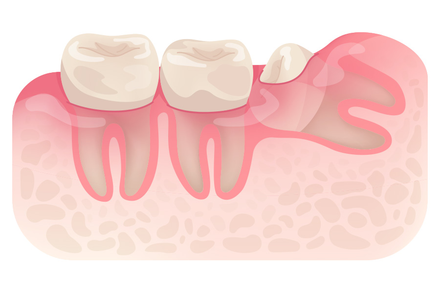 Partial Partial Impaction