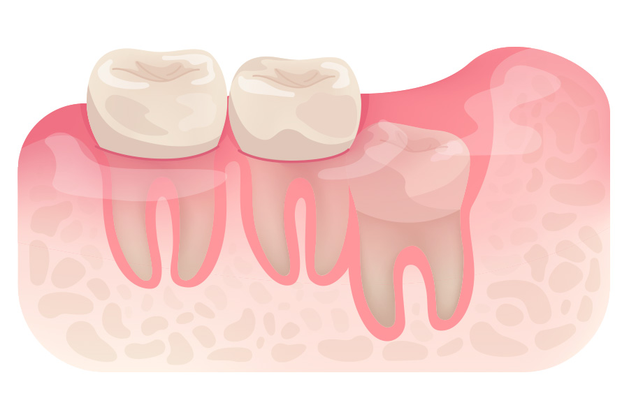 Vertical Vertical Impaction